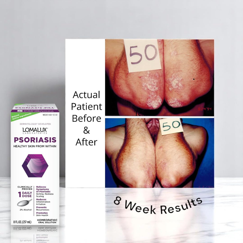 8 oz Psoriasis & Seborrheic Dermatitis Relief R12519